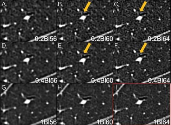 Ultra High Resolution CT scan of lungs demonstrates CT Imaging Advancements